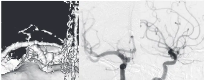 Fig.  3　Intraoperative  changes  of  right  stimulating VEP  in  Case  2.