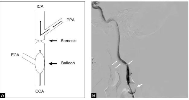 Fig. 5   A  DSA  image  shows  complete  resolution  of  the  stenosis and the opacified PPA.