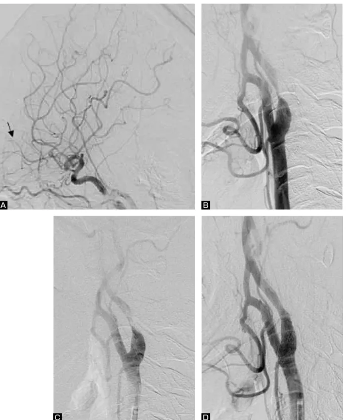 Fig. 2  Preoperative intracranial angiograms (A, B) and serial changes on left carotid angiograms (lateral views)(C, D)