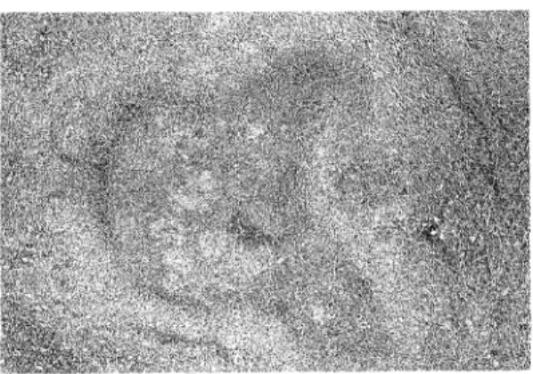 Fig.  2  Note  epithelioid  granulomas  with  central
