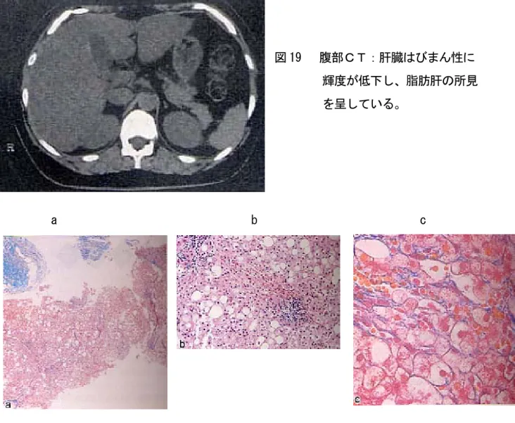 図 19   腹部ＣＴ：肝臓はびまん性に          輝度が低下し、脂肪肝の所見          を呈している。   a       b               c  図 20  肝組織所見  a 小葉構造は一部乱れている。実質の脂肪変性が目立ち、門脈域、実質内に線維の進 展がみられる（Azan-Mallory 染色） 。  b 実質には脂肪変性に加え、層状壊死が散見される。門脈域には炎症細胞浸潤が目立 つ（HE 染色） 。  c 類洞に沿い線維の進展、肝細胞周囲線維化を認める（Azan-Mal
