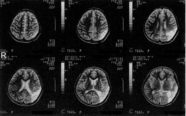 図 1 . 受傷後 3 か月時の頭部 MRIT2 強調画像（症例 1 ) る失語症の回復と脳の可塑性を明らかにするうえ での示唆が得られるのではないかと考えた． 以下，筆者らが追跡した後天性小児失語 2 症例 の経過を通して，失語症の回復と脳の可塑性につ いて考察したい． 症 例 1:  小児失語の早期回復と局所脳血流 3 3 ) 1) 基本情報 生育歴に特記すべき所見のない右手利き男児で ある