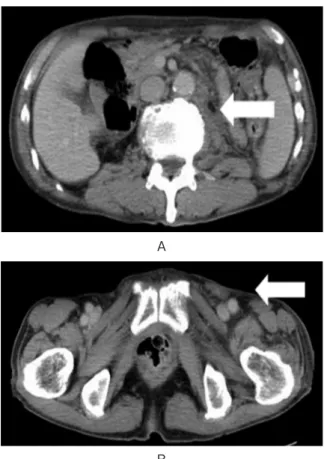 Fig. 2. After 3 cycles of GN therapy, enhanced computed tomography didn’t revealed the lymph node.
