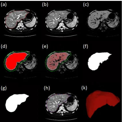 Figure 3.5: Steps of the RWNBT method. (a) The segmented liver (red) of the previous slice; (b) The current slice; (c) Candidate pixel by applying a threshold to the GMM; (d) The rough object (red) and background (green) seed points; (e) The fine seed poin