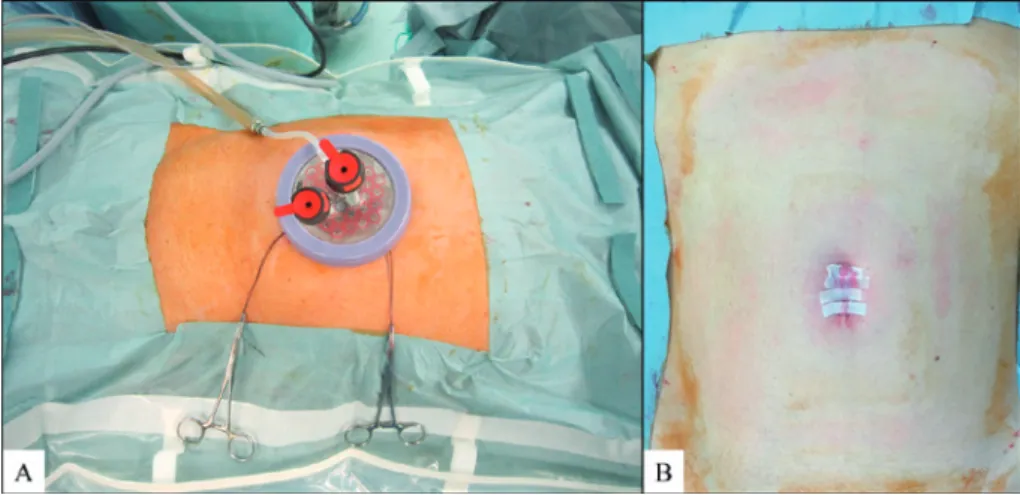 Fig. 1  Intraperitoneal ﬁndings of TULAA and skin incision.