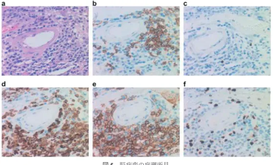 図 6 in situ hybridization a,b : κ  c,d : λ