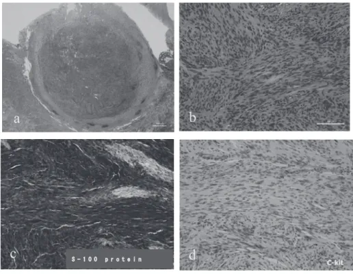 Fig. 4 a）  Hematoxylin - eosin  （HE）  ×1 ; b）  HE × 20 ; c）  S - 100 protein × 20 ; d）  c - kit × 20 