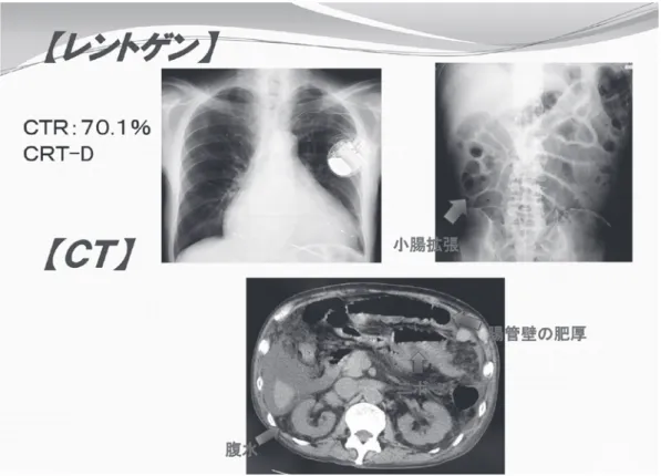 図 5 2 度目の入院時の x - p 像と腹部 CT 像。拡大した縦隔陰影とイレウス所見を認める。