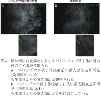 図 6 増殖糖尿病網膜症に対するベバシズマブ硝子体注射前 後の蛍光眼底造影所見 A ベバシズマブ硝子体注射前の蛍光眼底造影所見 （造影開始 35 秒） 新生血管からの蛍光漏出が観察される。 B ベバシズマブ硝子体注射 2 日後の蛍光眼底造影所 見（造影開始 38 秒） 新生血管からの蛍光漏出が著明に減少している。