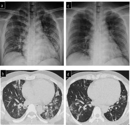 Figure 1. Chest X-ray and computed tomography ﬁndings of Case 1