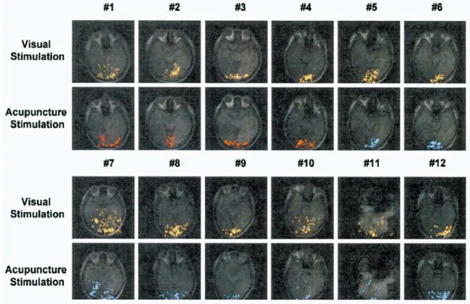 図 4  視覚刺激時  膀胱経の経穴への鍼刺激時  非経穴への鍼刺激時の fMRI 画像 (Cho ZH et al. Proc Natl Acad Sci 1998)