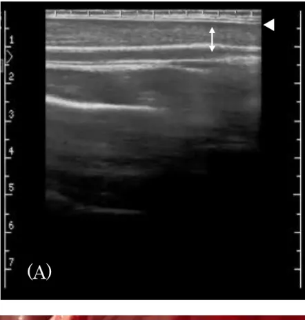 Fig 1.  症例 2 の開腹手術時の超音波所見(A)と肉眼所見(B) 