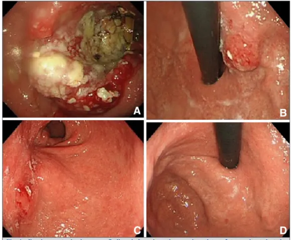 Fig. 2 Histopathological  examination  at  biopsy  showed  moderately  differentiated  type  adenocarcinoma  (A),  with  3+ HER2 expression (B)
