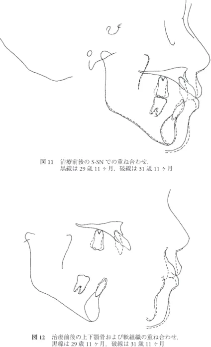 図 13 保定開始後 2 年 11 ヶ月 途中第三子を出産した際，上顎リテーナーを使用せず前歯部の配列に乱れが生じた． Overbite, overjet は維持している． 図 12  治療前後の上下顎骨および軟組織の重ね合わせ．黒線は 29 歳 11 ヶ月，破線は 31 歳 11 ヶ月図 11  治療前後の S-SN での重ね合わせ．黒線は 29 歳 11 ヶ月，破線は 31 歳 11 ヶ月
