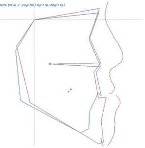 Fig 6 Treatment goal（paper surgery） ．Fig 5Profilogram.