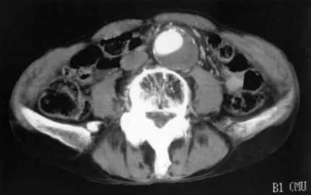 Fig. 2 On admission abdominal computed tomography scan showed the abdominal aortic aneurysm measuring 5 cm in diameter, which was completely occupied by the thrombus.
