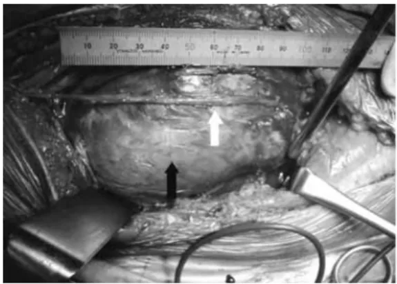 Fig. 2 Intraoperative view before excision of aneurysm.