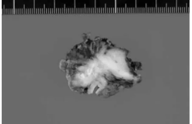 Fig. 4 The tumor from the groin has a pale, fibrous cut surface with dense calcification.