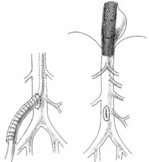 Fig. 1 Preoperative thoracic computed tomography scan showed a saccular aneurysm at the distal portion of the descending aorta with intraluminal thrombus (arrows) and an ill-defined tumor in the right lower lobe of the lung (empty arrows).
