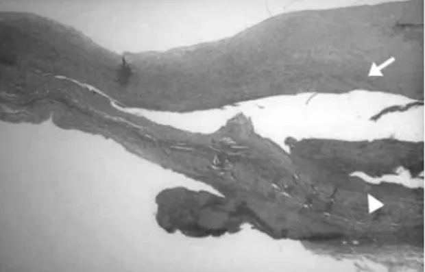 Fig. 1 Contrast-enhanced computed tomography shows dissec- dissec-tion (arrow) of the infrarenal aorta.