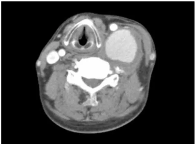 Fig. 2 Preoperative 3D-computed tomogram. The inflow artery of an aneurysm was the inferior thyroid artery