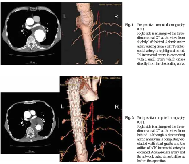 Fig. 2 Postoperative computed tomography (CT).