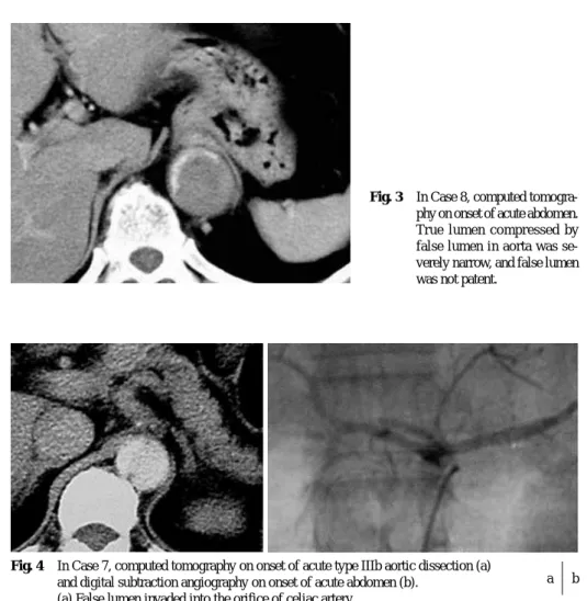 Fig. 3 In Case 8, computed tomogra- tomogra-phy on onset of acute abdomen.
