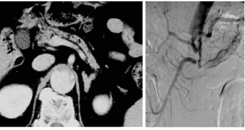 Fig. 5 In Case 4, computed tomography (a) and digital subtraction angiography (b) on onset of acute type IIIb aortic dissection.