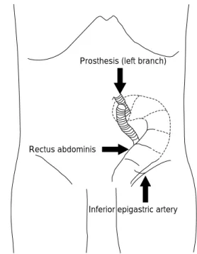 Fig. 3 Schematic of the rectus abdominis muscle flap for ab- ab-scess cavity in the second operation.