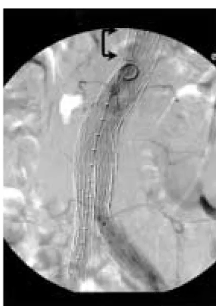 Fig. 1 IA-DSA before endografting. Several lumbar arteries were patent.