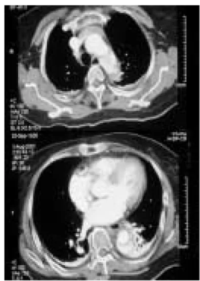 Fig. 2 Computed tomogram (maximum intensity projection) showed aortic dissection with almost thrombosed false lumen from distal arch to above bifurcation of aorta.