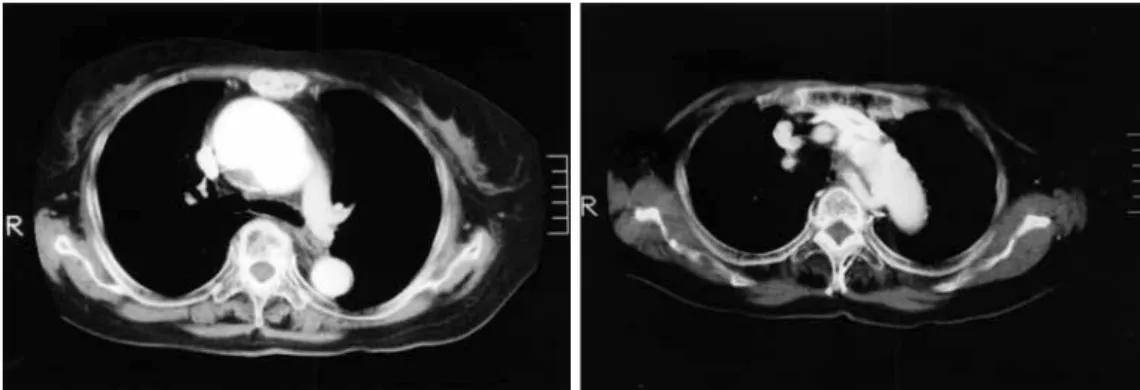 Fig. 2 Postoperative angiogram shows ARSA, whose orifice has no change compared with preoperative angiogram.
