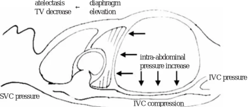 Table 3 Consideration of clinical suggestion according to values of intra-ab- intra-dominal pressure (IAP) for postoperative management of ruptured  ab-dominal aortic aneurysm