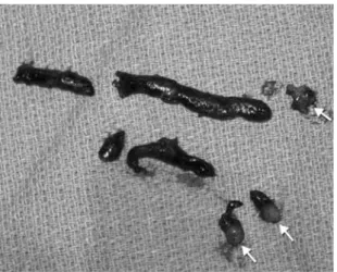 Fig. 2 Thrombus and white clot (arrows).