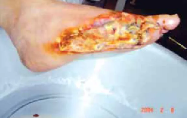 Fig. 3 After maggot debridement therapy (2 weeks).