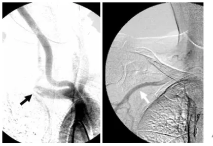 Fig. 2 Case II: Preoperative angiogram.