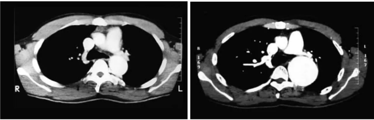 Fig. 2 The angiogram shows the thoracic pseudoaneurysm.