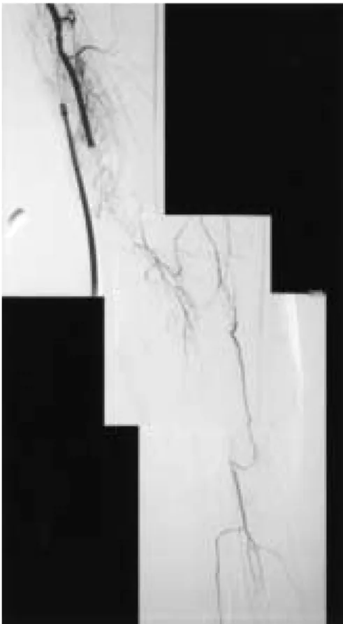Fig. 3 Preoperative left arm angiography of case 2. Brachial artery is occluded above the elbow and only anterior interosseus artery is visualized through the collateral flow.