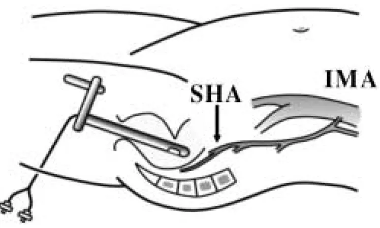 Fig. 1 A commercially available Doppler probe was mounted on the tip of plastic tube, which was inserted transanally into the rectum to detect the Doppler sound of the SHA.