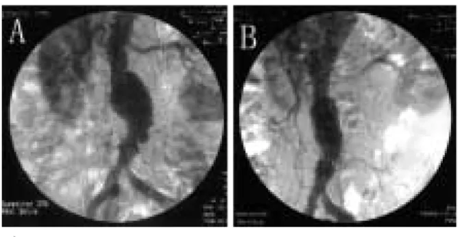 Fig. 1 A: Preoperative DSA