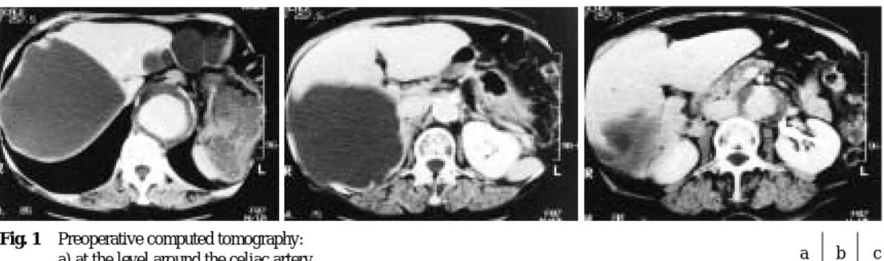 Fig. 2 Preoperative aortography and its schematic figureFig. 1Preoperative computed tomography: