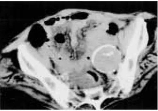 Fig. 2 The barium enema shows obstruction (arrow) at the level of sigmoid colon.