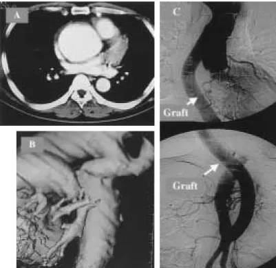 Fig. 2 Preoperative CT showing a dilated aor- aor-tic root (A) and dislocated left  subcla-vian artery and coarctation of the aorta (B) in case 7