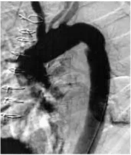 Fig. 4 There was no particular findings of aortic aneurysm and dissection at aortography.