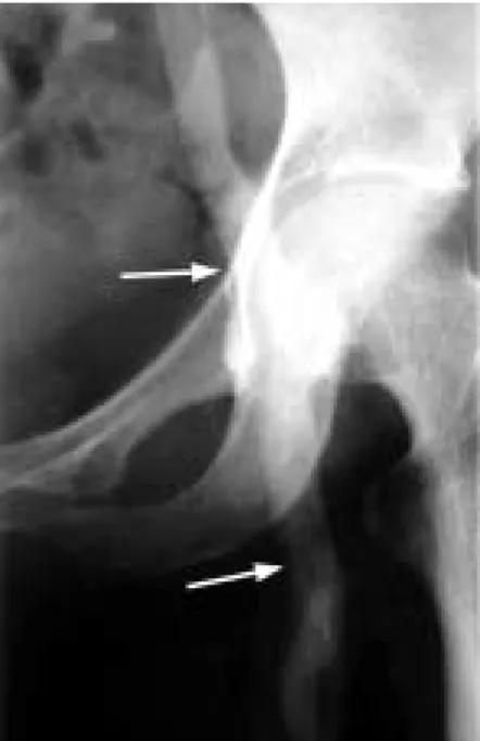 Fig. 6 Intraoperative findings show the compound vein graft interposed between the deep veins.