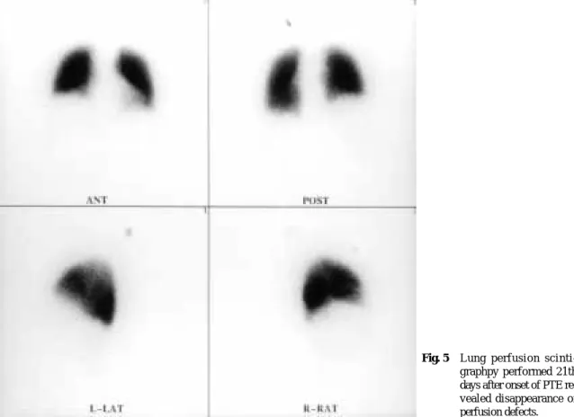 Fig. 5 Lung perfusion scinti- scinti-graphpy performed 21th days after onset of PTE  re-vealed disappearance of perfusion defects