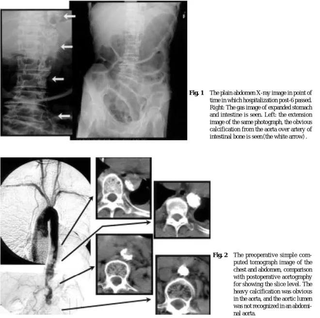 Fig. 1 The plain abdomen X-ray image in point of time in which hospitalization post-6 passed.