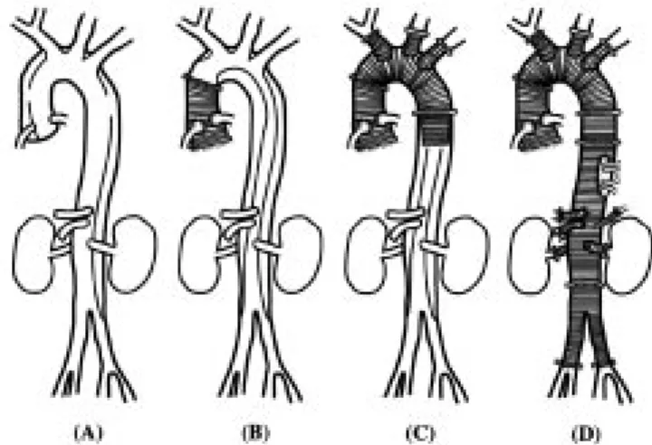 Fig. 3 Schema of the process of the total aortic replacement.