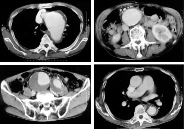 Fig. 1 Preoperative computed tomograms show the aneurysms of (a) the distal arch aorta 72mm, (b) the abdominal aorta 62mm, and (c) the right common iliac artery 67mm in maximal diameter, and Stanford type B aortic dissection with thrombosed false lumen of 