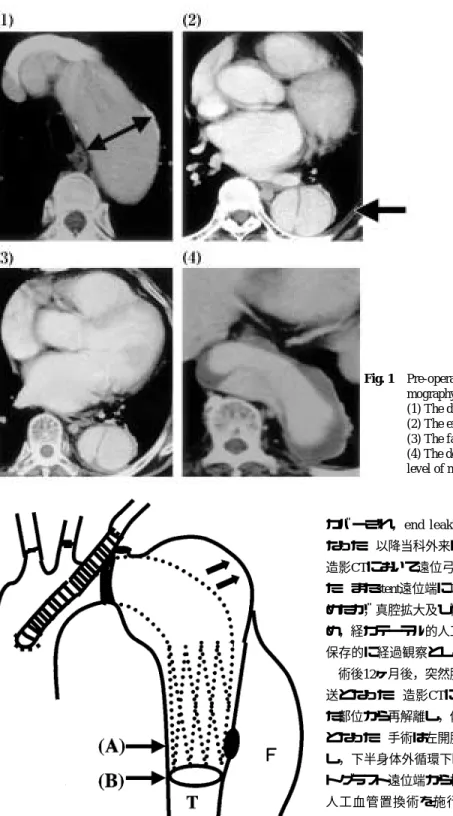 Fig. 1 Pre-operative contrast-enhanced computed to- to-mography.